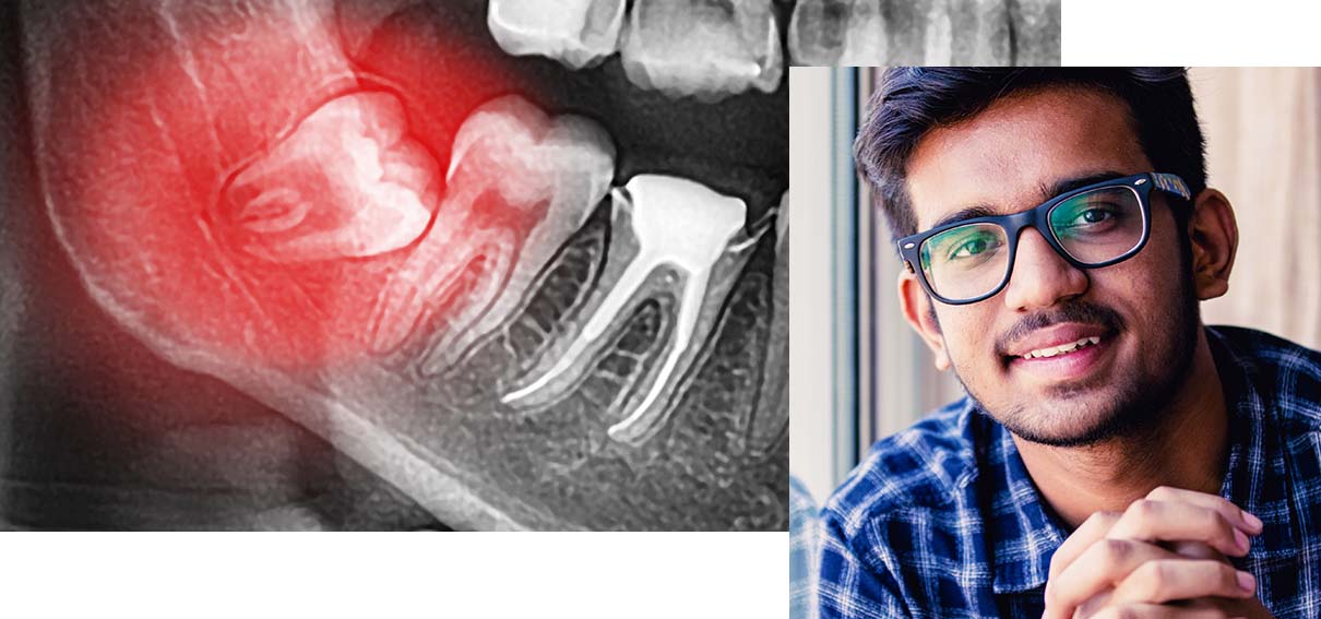 Wisdom teeth X-Ray. Inset of man smiling.
