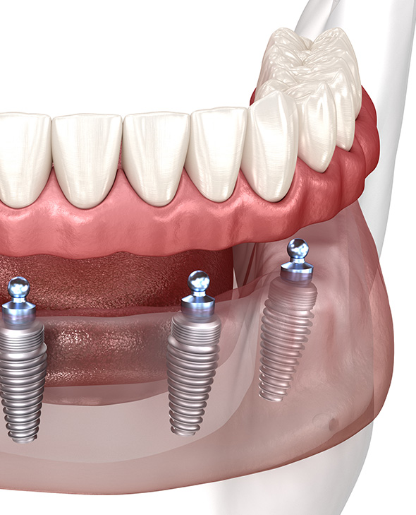 denture-implants-3
